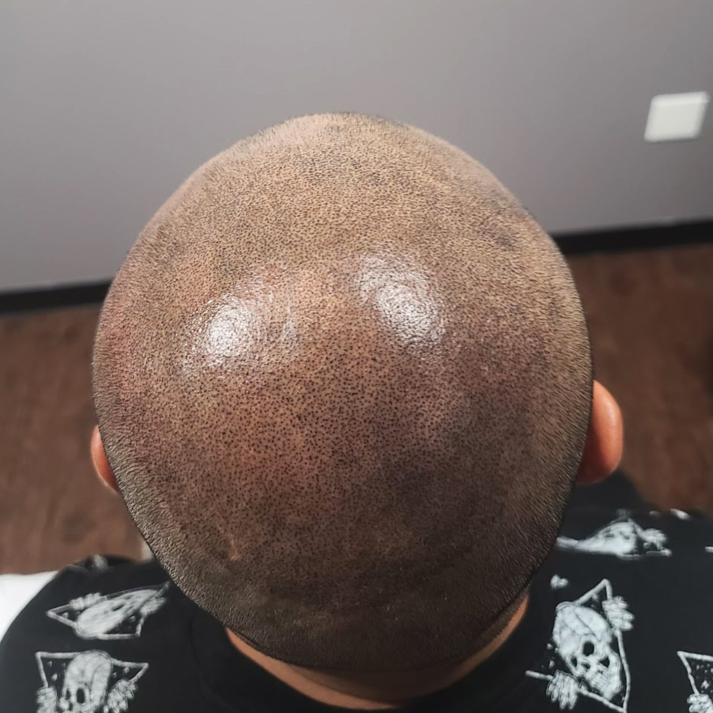 Scalp Micropigmentation (SMP)