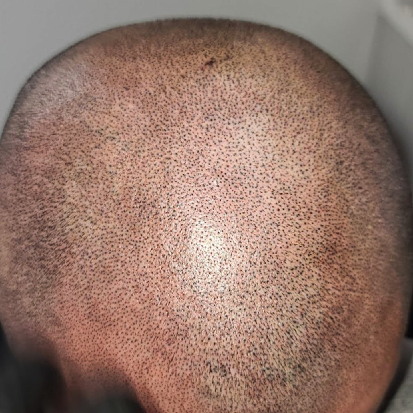 Scalp Micropigmentation (SMP)