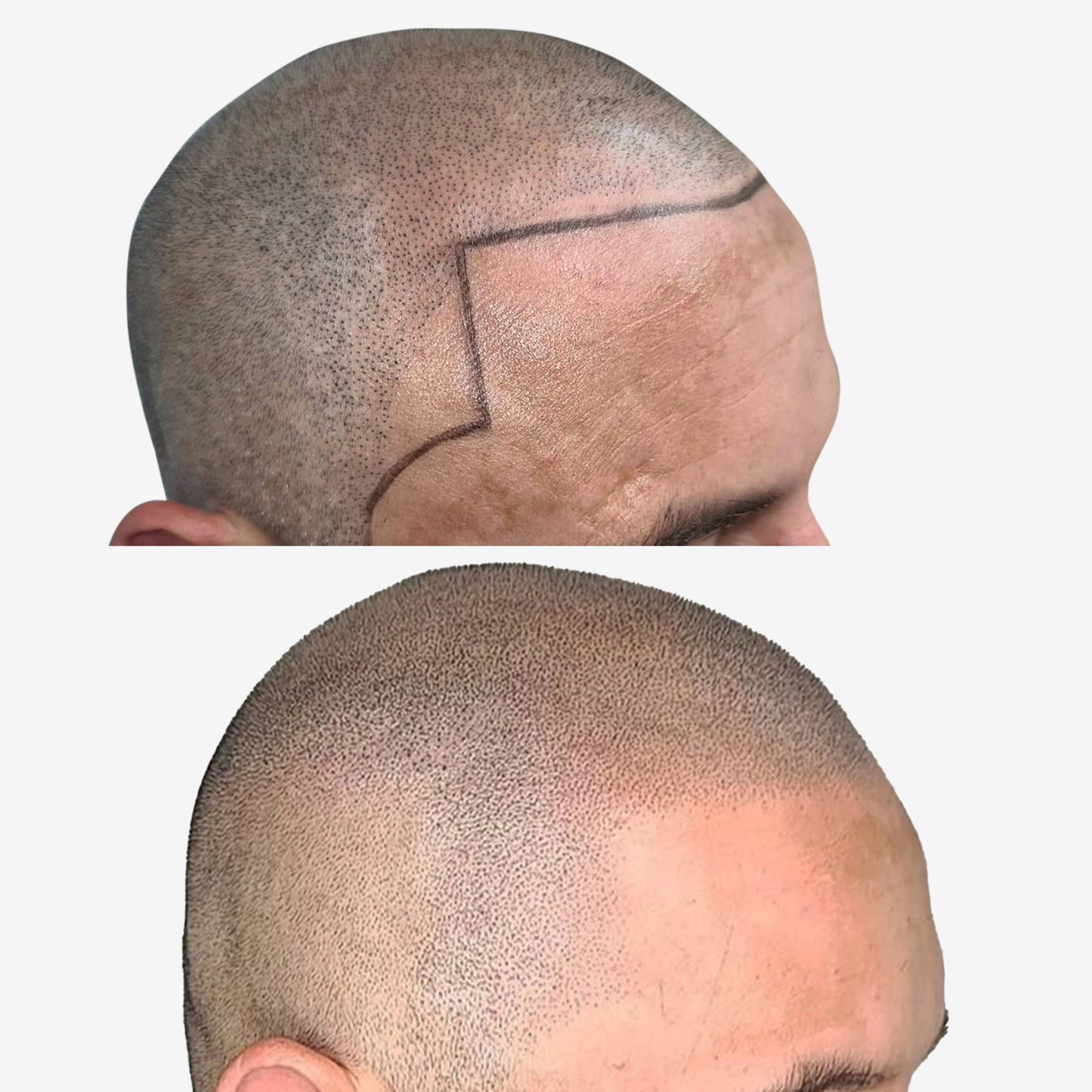 Scalp Micropigmentation (SMP)