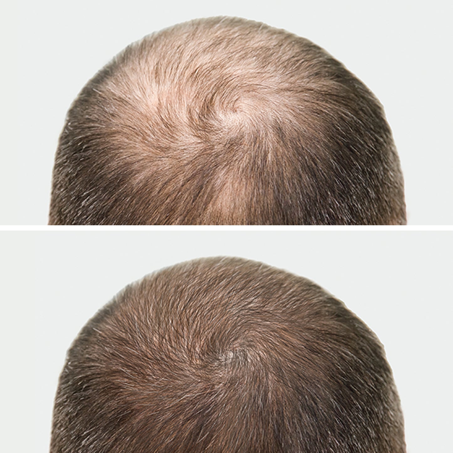 PRP Hair Restoration