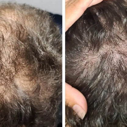 Scalp Micropigmentation (SMP)