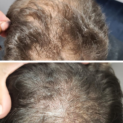 Scalp Micropigmentation (SMP)