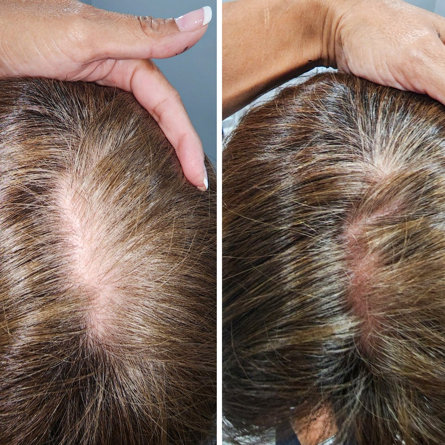 PRP Hair Restoration